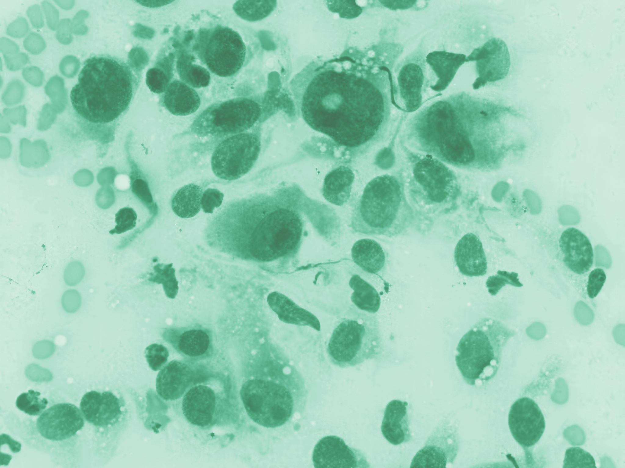 Why Early Cancer Detection is Critical and Reliable: Affordable Diagnostic Solutions for Every Practice